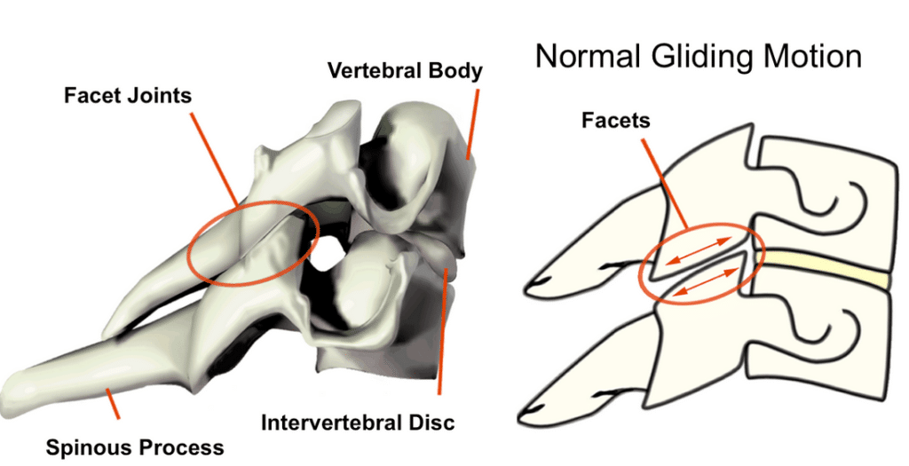 Here is a study showing facet damage in a MVC Professionally